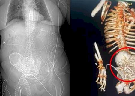 ''Bebê de pedra'': idosa descobre feto calcificado que carregou por 56 anos em MS